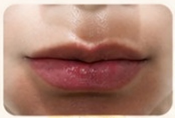 Bibir sebelum filler