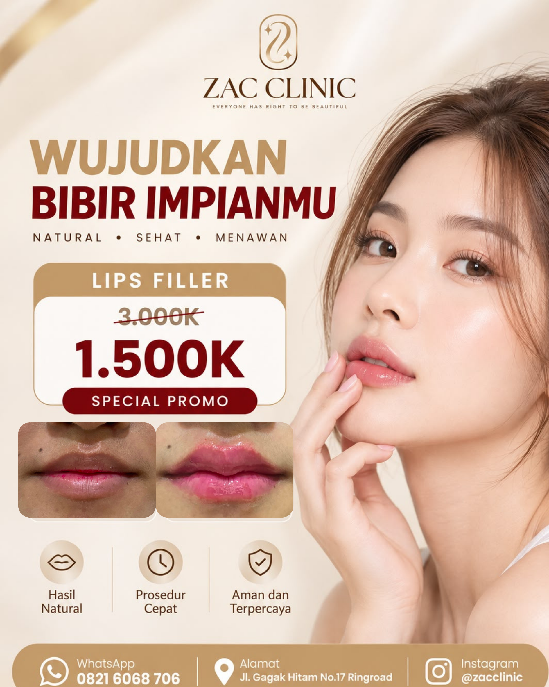 Filler Bibir -Best Seller