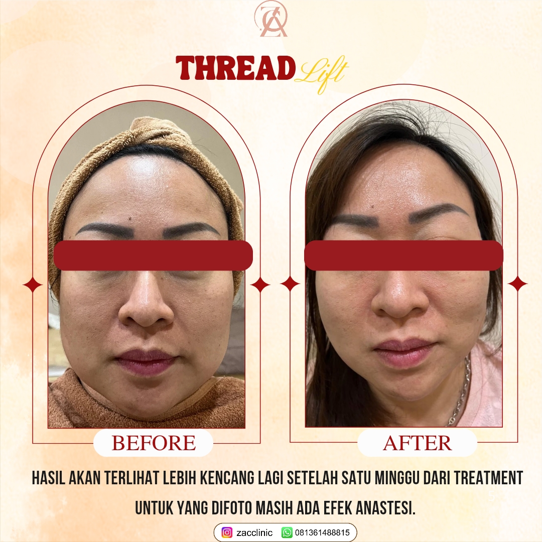 Threadlift Before&After