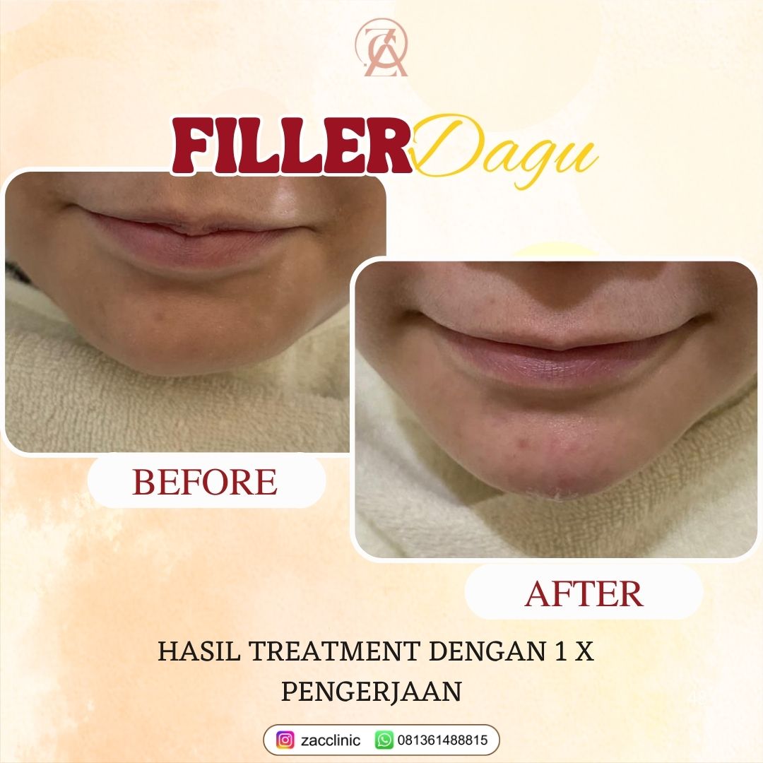 Filler Dagu Before&After