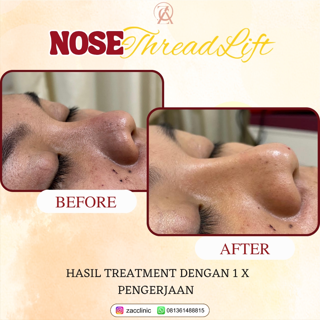 Nose Threadlift Before&After
